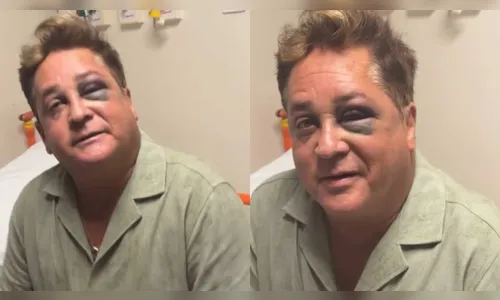 Leonardo surge inchado, de olho roxo e preocupa fãs; veja o que aconteceu