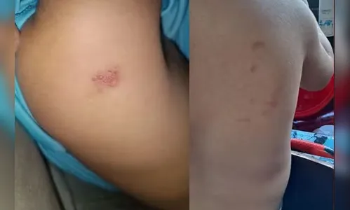 Mãe coloca gravador na mochila de filho e professora é afastada por maus-tratos