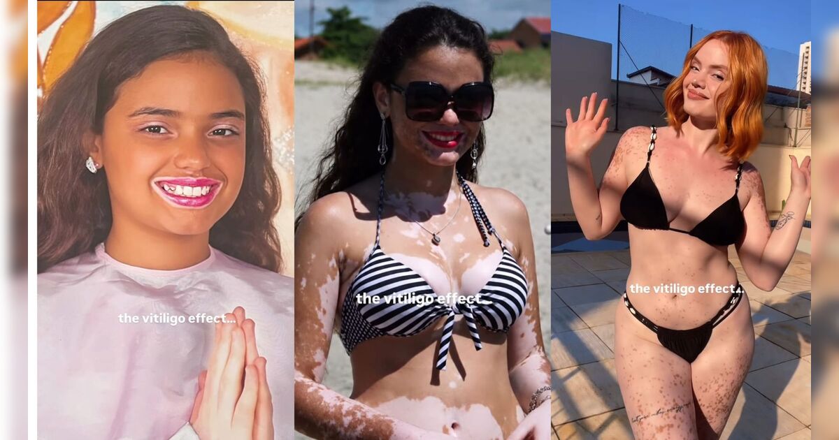 Vídeo de influencer apucaranense viraliza e mostra efeitos do vitiligo ao longo dos anos
