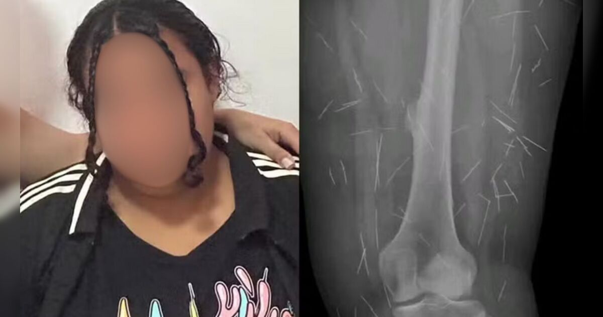 Presa em SC por fingir ser criança, mulher usou agulhas no próprio corpo para forjar abusos em Goiás
