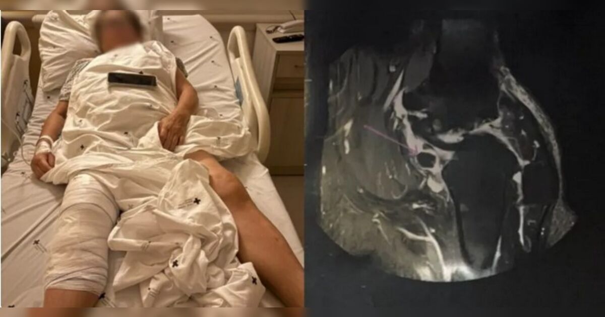 Paciente de 72 anos na cama do hospital após cirurgia no joelho
