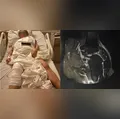 Idosa acorda de cirurgia e descobre que prótese foi colocada no joelho errado em hospital de Curitiba
