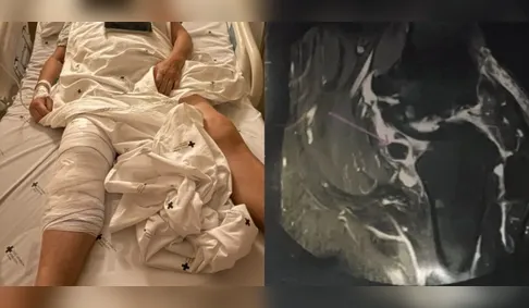 Hospital se pronuncia após cirurgia realizada no joelho errado de idosa no PR