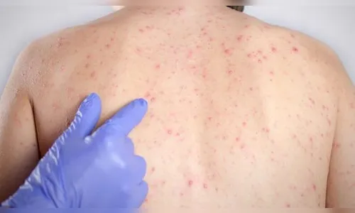 Casos novos de sarampo não são registrados no Paraná há mais de um mês