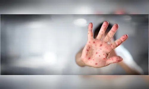 Paraná completa mais uma semana sem novos casos de sarampo