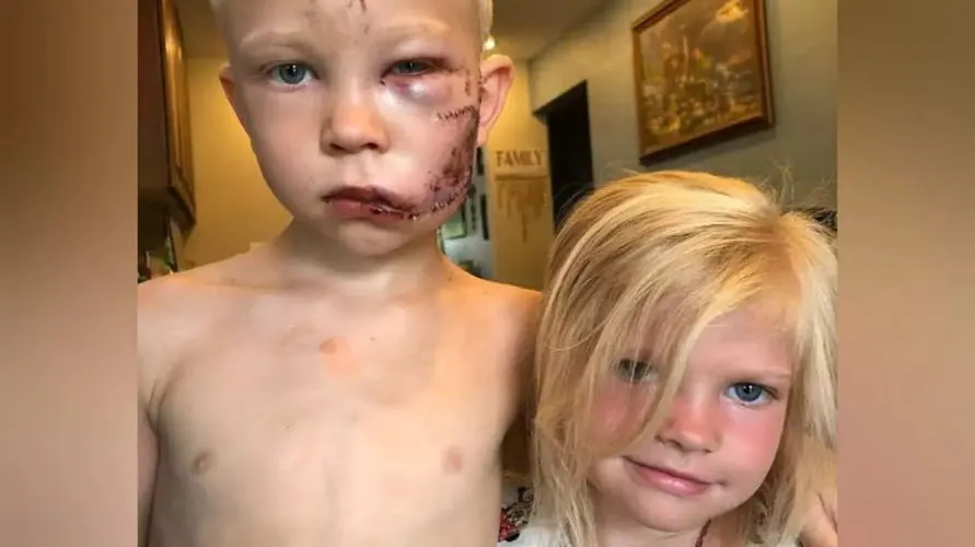 Menino de 6 anos tem rosto desfigurado por cachorro ao salvar irmã