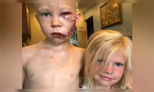 Menino de 6 anos tem rosto desfigurado por cachorro ao salvar irmã