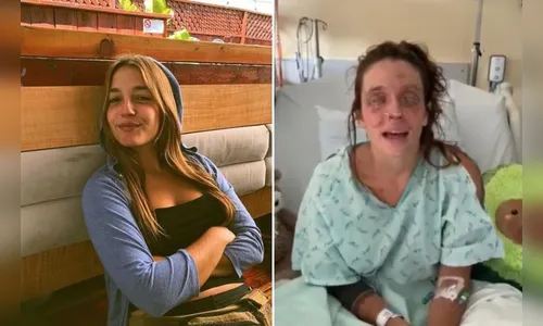 Jovem fica cega após acidente com maquiagem feita em casa