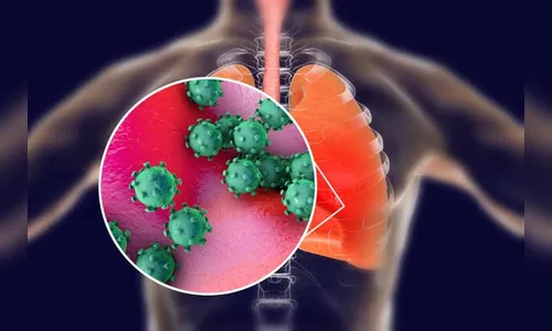 Arapongas registra 18 novos casos de Covid-19, 87 curados e um óbito