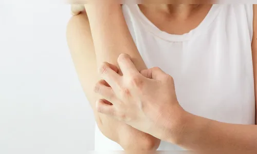 Segundo pesquisadores, pacientes com covid-19 prolongada podem ter problemas de pele