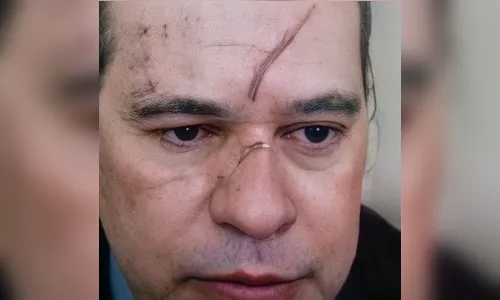 Dias Toffoli chama atenção ao surgir com hematomas no rosto