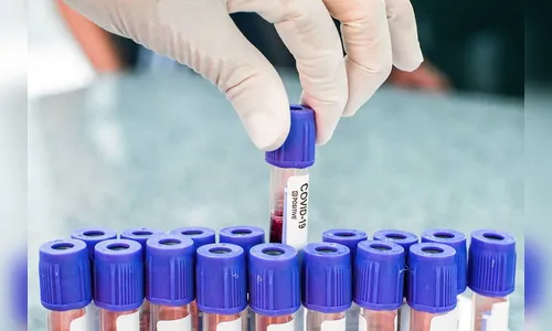 Apucarana tem 16 novos registros de Covid e ultrapassa 2,2 mil casos