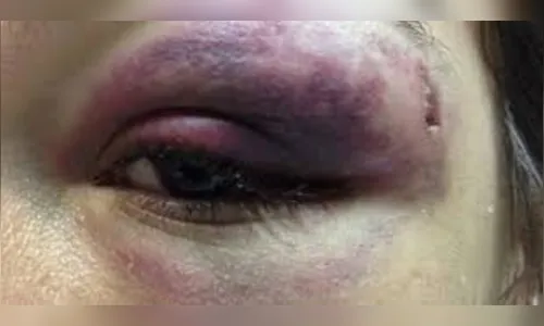 PM atende mulher espancada pelo marido em Arapongas; Quebrou dentes