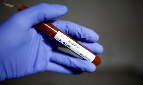 Ivaiporã confirma um caso positivo do novo coronavírus (Covid-19)