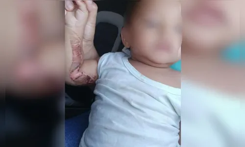 Bebê é resgatado após sofrer queimadura com carvão