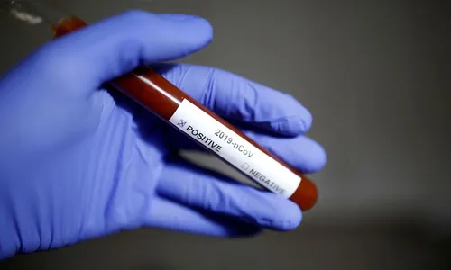 Jardim Alegre registra quatro novos casos de Covid-19 na segunda (1º)