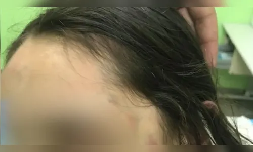 Mãe investigada por maus-tratos ameaçou filha com chumbinho