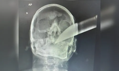 Homem sobrevive após ter facão cravado na cabeça