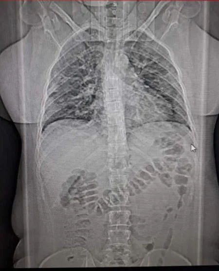 Na foto, tomografia dos pulmões da sobrinha, com 60% de infecção