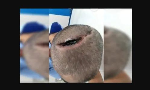 Depois de ser intubado homem acorda com cabeça rachada