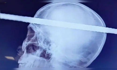 Homem sobrevive após ter cabeça perfurada por barra de 6 m