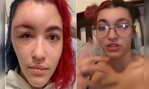 Rosto de jovem fica deformado por alergia à tinta de cabelo