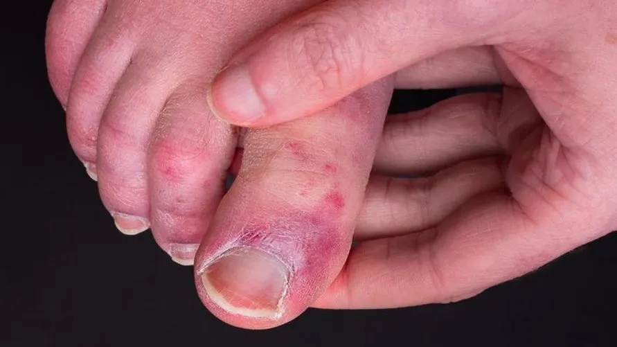 Pessoas desenvolvem lesões nos dedos após contraírem covid
