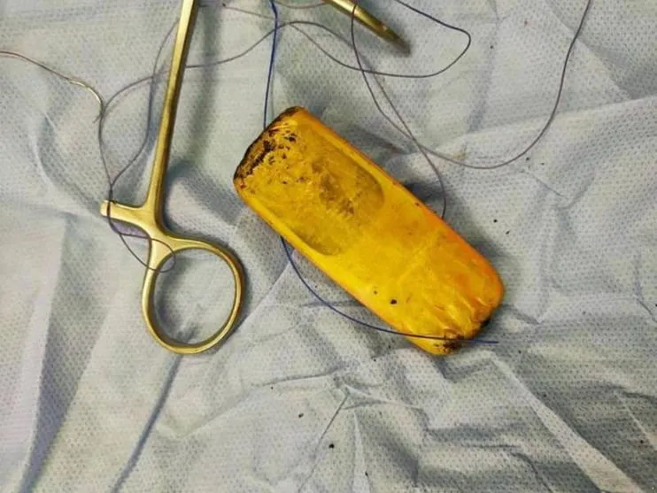 Preso passa por cirurgia após ficar com celular no estômago