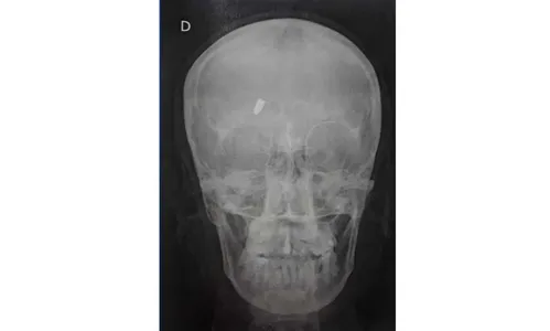 Com dor, mulher vai ao hospital e descobre que levou tiro