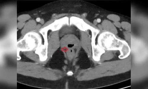 Homem passa 2 anos fazendo cocô pelo pênis; entenda