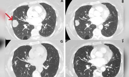 Tumor no pulmão de mulher reduz 76% após uso de canabidiol