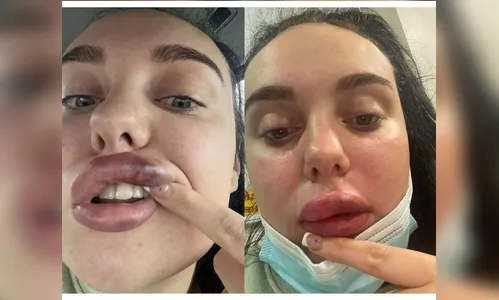 Mulher quase perde a visão ao fazer preenchimento labial