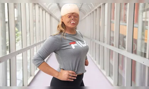 Mulher que teve 88% do corpo queimado se torna modelo