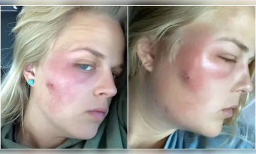 Mulher vai parar no hospital ao tentar espremer espinha