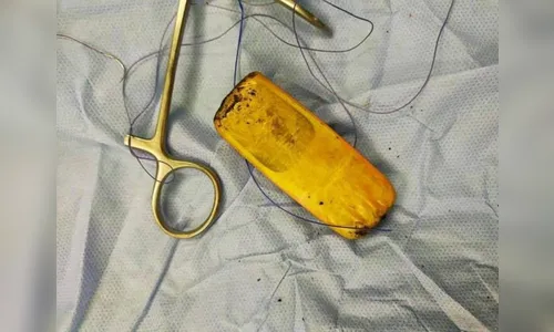 Preso passa por cirurgia após ficar com celular no estômago