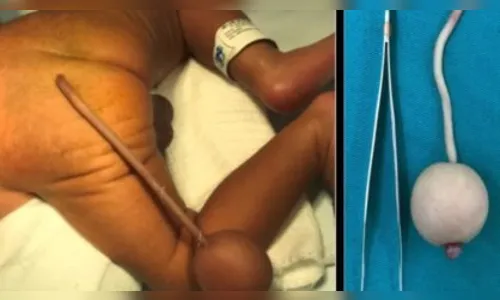 Raro: bebê brasileiro nasce com cauda e bola na extremidade