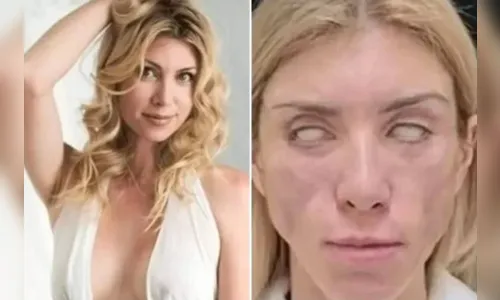 Após cirurgia plástica, miss não consegue fechar os olhos