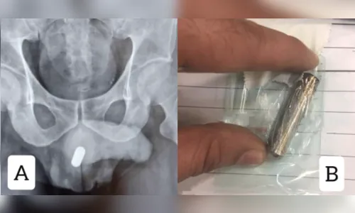 Homem introduz objeto inusitado e acaba no hospital