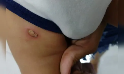 Suspeito de torturar bebê com bituca de cigarro é preso