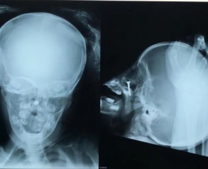 Médicos encontram parafuso em nariz de criança de 2 anos