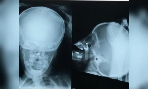 Médicos encontram parafuso em nariz de criança de 2 anos