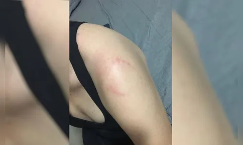 Mulher leva mordida após esbarrar em homem na academia; veja