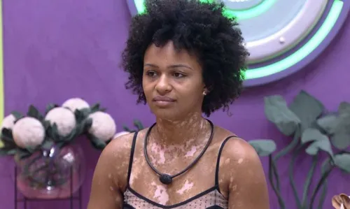 Natália é alvo de ataques preconceituosos por conta de vitiligo