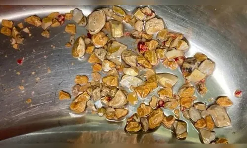 Médicos retiram 206 pedras dos rins de paciente; entenda