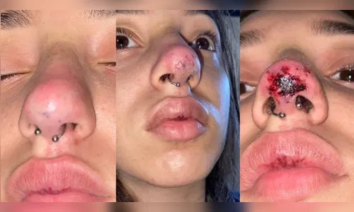 Jovem fica com o nariz necrosado após procedimento estético
