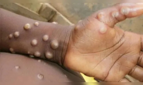 Varíola de macacos: brasileiro é 1º infectado na Alemanha