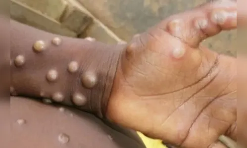 Varíola dos macacos chegará ao Brasil em breve, diz médico