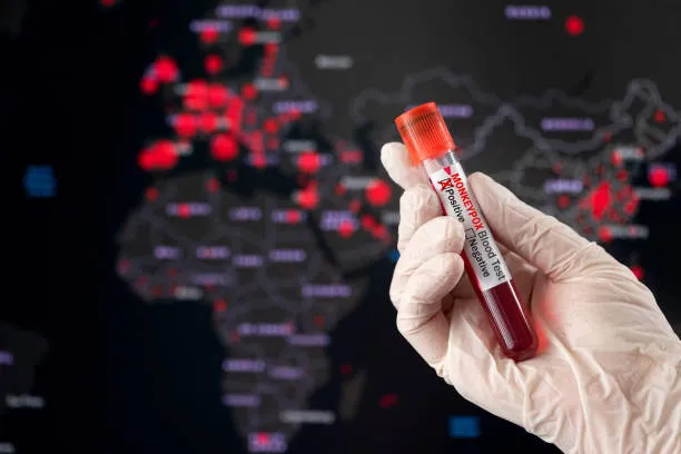 76 casos de varíola dos macacos foram confirmados em todo o país