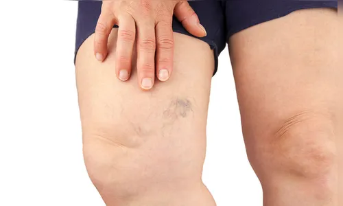 Cinco sintomas vasculares que podem surgir após a Covid-19; confira