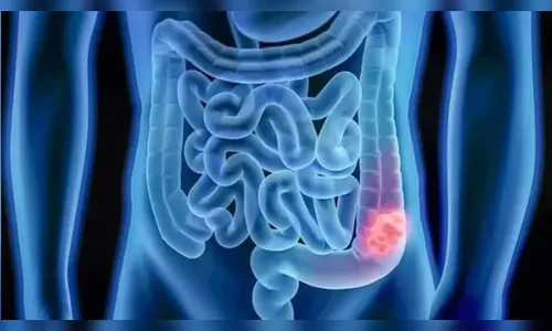 Imunoterapia realizado em estudo cura câncer em 14 pacientes